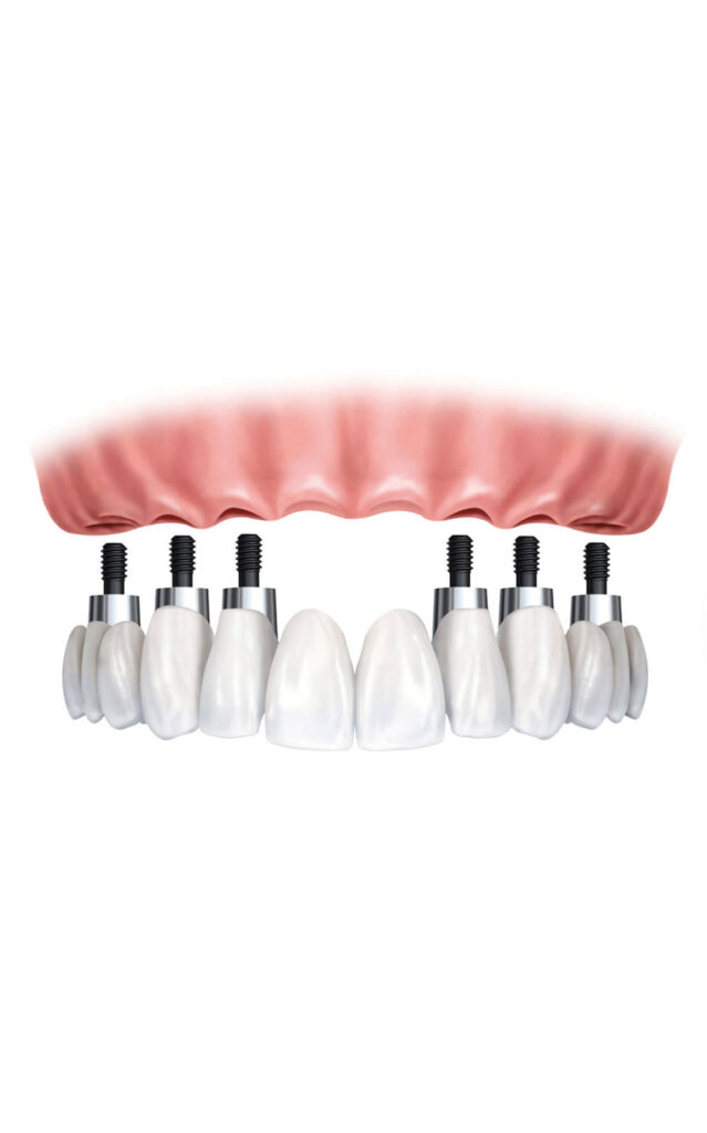 full arch dental implants